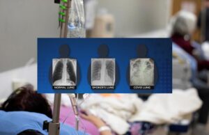 FOTO IMPACTANTE: muestran que los pulmones después del coronavirus se ven peor que el de los de fumadores
