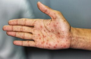 Incrementaron los casos de sífilis en el país
